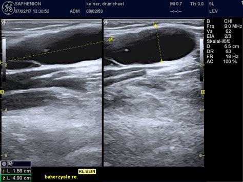 Baker S Cyst On Ultrasound