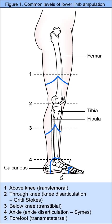 How Long Is Recovery From Below Knee Amputation