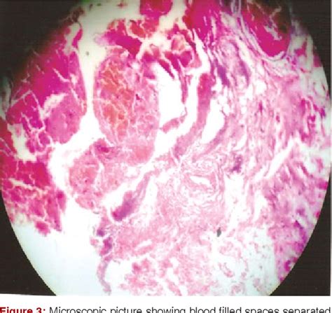 Figure From Bony Hemangioma Of Maxillary Sinus A Rare Presentation