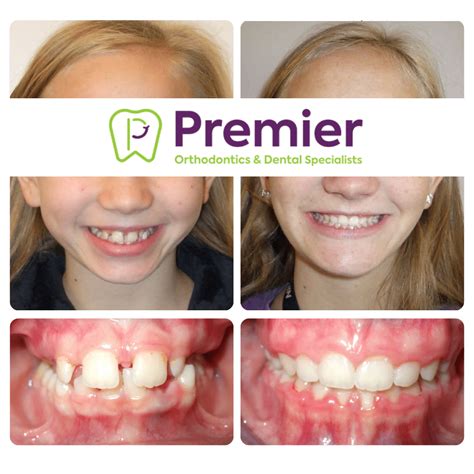 afters premier orthodontics dental specialists