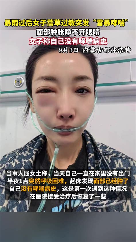 暴雨过后女子蒿草过敏突发雷暴哮喘面部肿胀睁不眼睛 直播吧