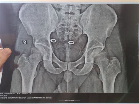 Ask a Physiotherapist Online for I Feel Pain In The Top Border Of The