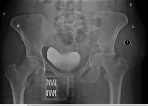 Pelvic Bone Fracture