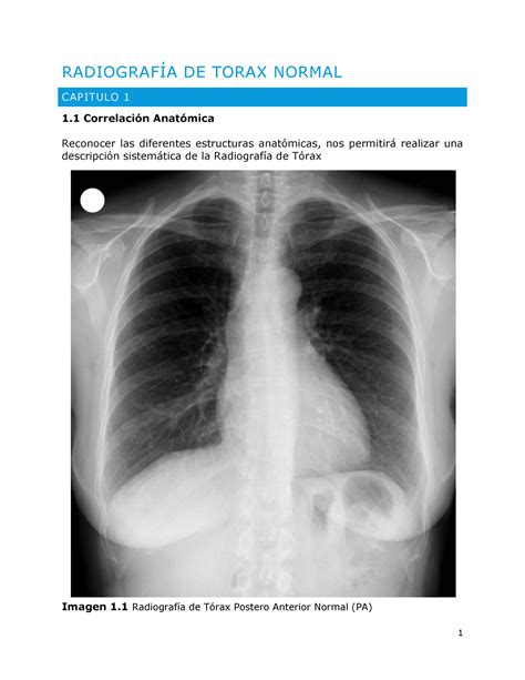 Radiografia Normal Caracter Sticas Radiograf A De Torax Normal