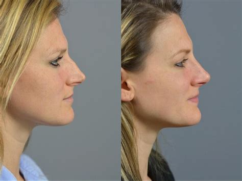 Nose Surgery Before After Long Island Dr James Marotta