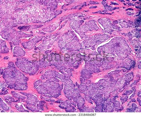 cancer solid tumors   royalty  licensable stock