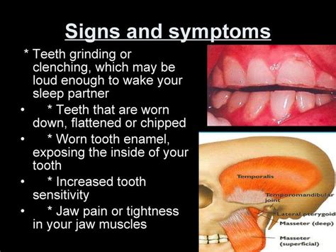 bruxism