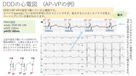 不整脈：ペースメーカーについて その5；DDDについて 〜基本37〜 - 誰でもわかる先天性心疾患