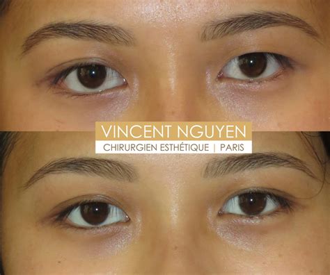 Bl Pharoplastie Asiatique Paris Chirurgie Des Paupi Res