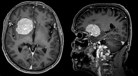 Hirntumor Gehirntumor Diagnose Und Behandlung Ksw