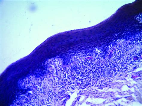 Photomicrograph of lichen planus showing epithelium with elongated rete ...