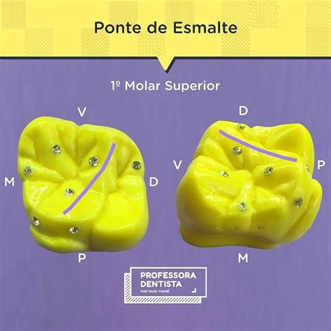 Ponte De Esmalte Primeiro Molar Superior - Dr. - Posted @withregram • @professoradentista "Ponte de Esmalte" no ...