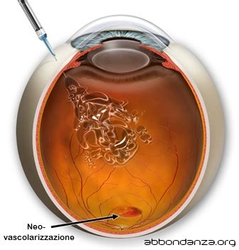 Iniezioni Intravitreali Per Maculopatia A Roma E Milano Iniezioni