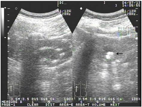 Sonography of the left kidney. A hyperechoic mass measuring 8 mm in... | Download Scientific Diagram