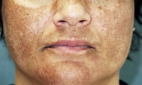 Melasma Como Tratar Em Casa Passo A Passo Receitas E Dicas Cura