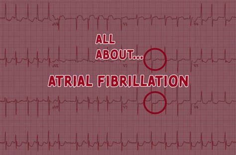 All Aboutatrial Fibrillation Easy Money Medic