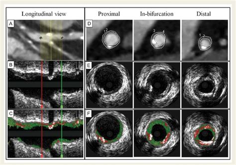 Bifurcation Matching And Analysis By MDCT And IVUS VH To Ensure