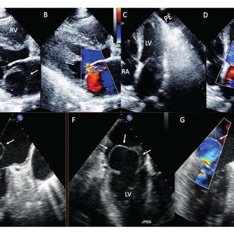 transthoracic  doppler echocardiography   parasternal long axis