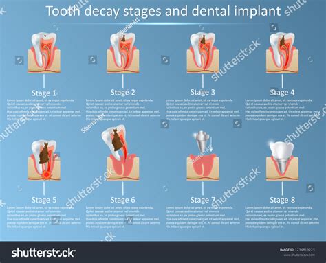 caries stages