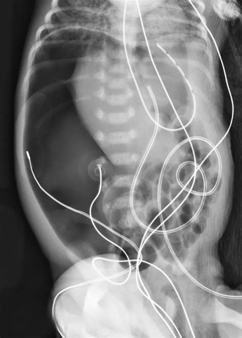 Spontaneous Intestinal Perforation | Applied Radiology