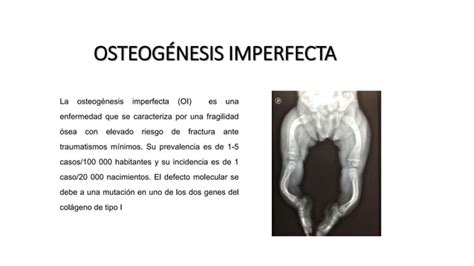 Tipos Causas Osteogenesis Imperfectapptx