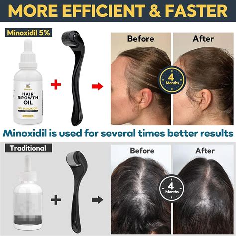 Minoxidil Derma Roller Kit For Hair Growth W Serum Oil Biotin