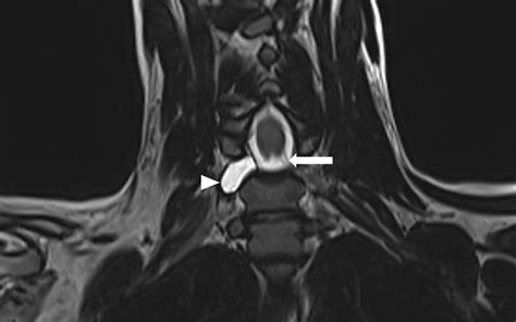 Paralysie Du Plexus Brachial De Ladulte Centre Main Epaule Mediterran E