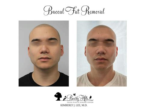 Buccal Fat Removal Before & After Photos | Dr. Kimberly Lee