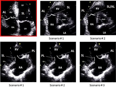 Anatomy Of Tricuspid Valve Tricuspid Valve Cardiac Sonography Echo