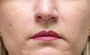 Juvederm Dermal Fillers In Bakersfield CA Botox Laser And Skin Care