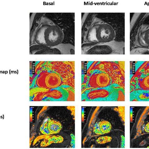 Multiparametric Cardiac Magnetic Resonance Imaging In A 47 Year Old