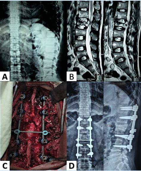 Long Segment Posterior Fixation A Preoperative X Ray Of The