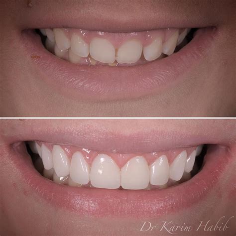 Composite Veneers Sydney | Dental Bonding Sydney - Dentist Ryde ...