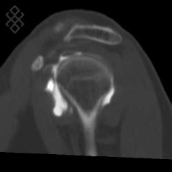 Arthroscanner De L Paule D Finition D Roulement Prise De Rdv En