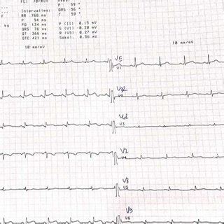 A Electrocardiogram At Admission Showing An St Elevation In The