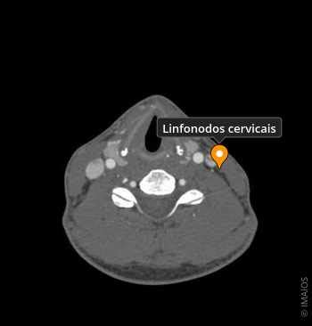 Linfonodos Cervicais Ossoscranio_1