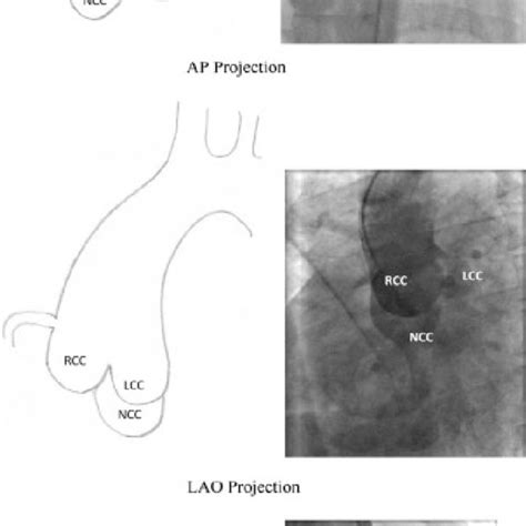 Aortogram And Schematic Representation Of Aortic Cusps In Aortic Root