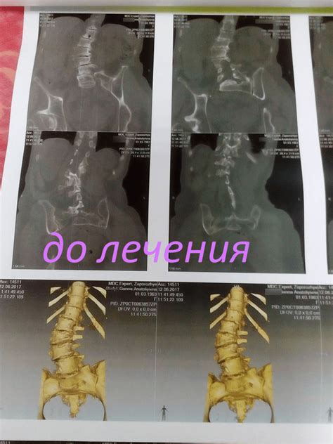 сколиоз поясничного отдела в возрасте 55 лет - результат лечения