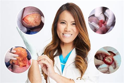 Meet Dr Pimple Popper The Woman Whos Made £5million Squeezing Spots