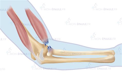 Rupture Biceps Brachial – Distal biceps tendon injury – WWER