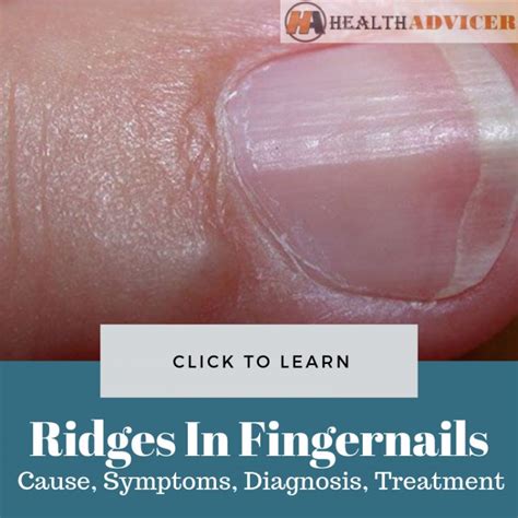 Ridges On Fingernails: Causes, Picture, Symptoms And Treatment