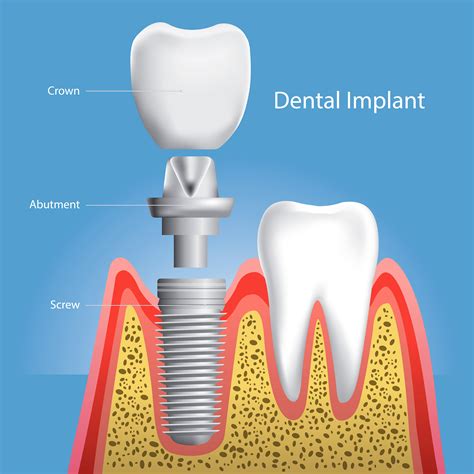 Best Dental Implants Smiles Belleville