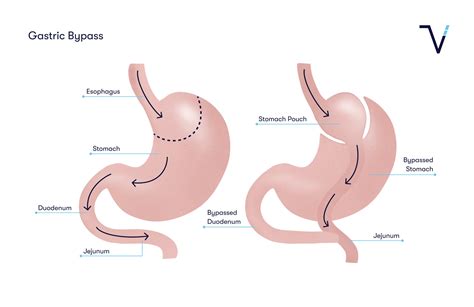 Faqs Gastric Bypass Alberta Vital Bariatrics Vital Bariatrics