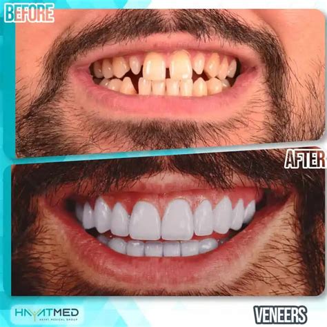 Veneers In Turkey 10 Year Real Warranty At Best 2024 Price