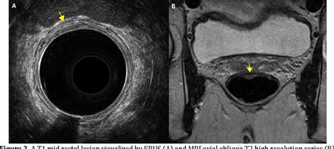 Figure From Evaluation Of Endorectal Ultrasound Erus And Mri For