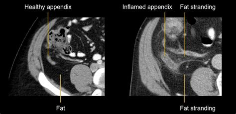 Abdominal Ct Common Terms • Litfl • Radiology Library