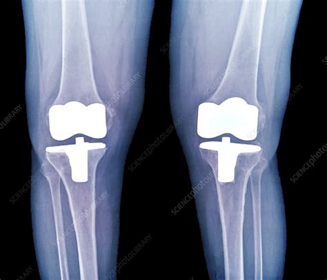 Bilateral Total Knee Replacement X Ray Stock Image C004 1484