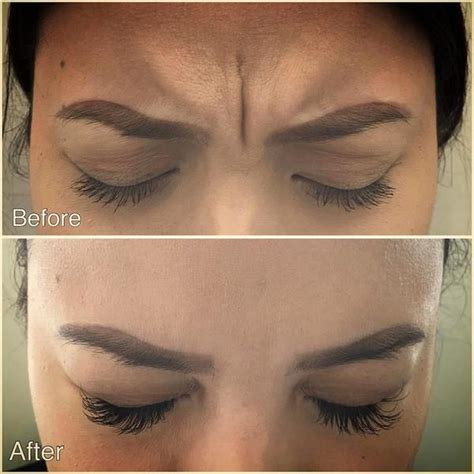 Incredible Before And After Pictures Of Deep Glabella Lines Being