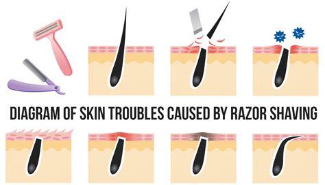how to get rid of razor bumps instantly