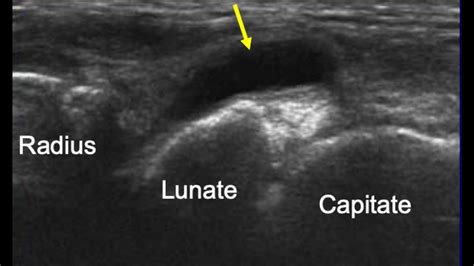 Arthrocentesis of the Wrist Joint - Internet Book Of MSK Ultrasound